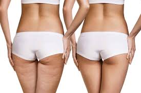 Carbossiterapia: cos'è, benefici e rischi